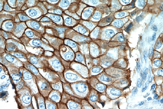 Painel Imunohistoquímico para Câncer de Mama