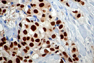 Painel Imunohistoquímico para Câncer de Mama